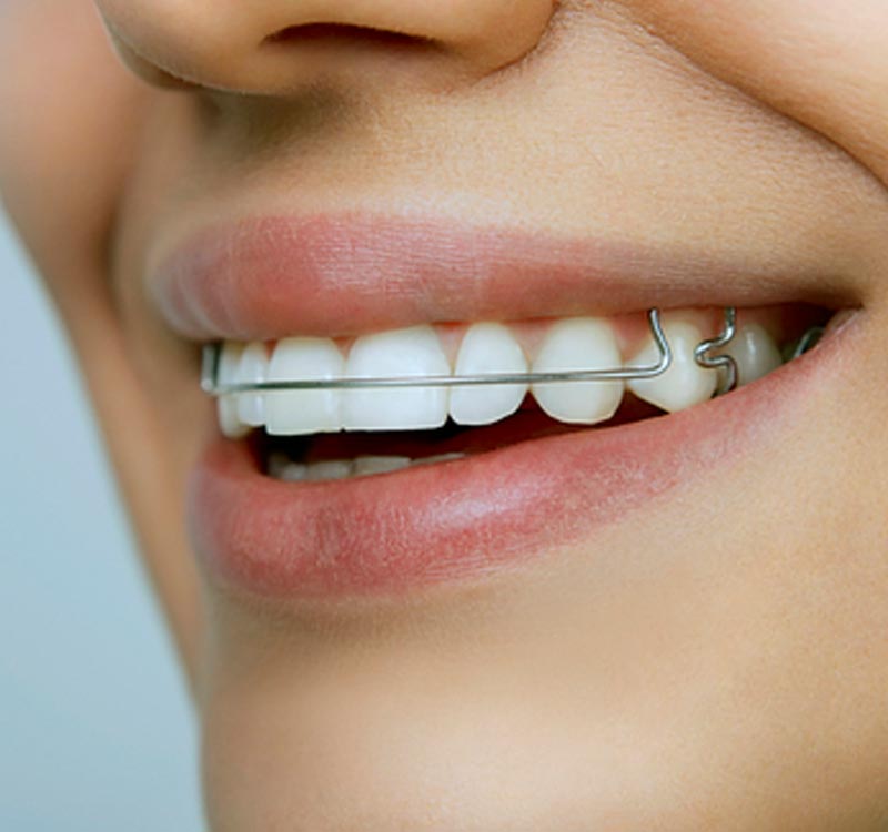 Orthodontics in West Sussex - retainer brace